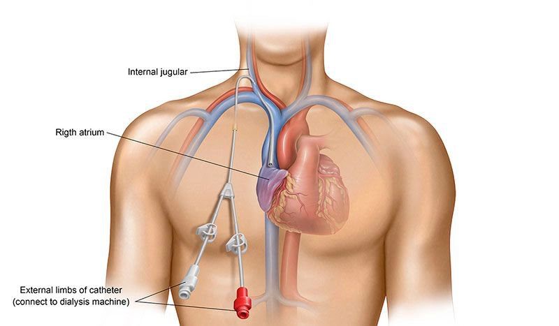 Đặt Catheter tĩnh mạch trung tâm