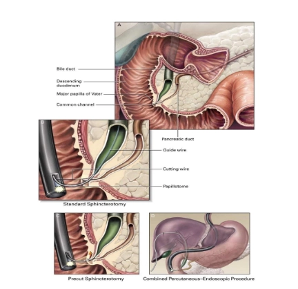 Các kỹ thuật cắt cơ vòng Oddi trong nội soi mật tụy ngược dòng