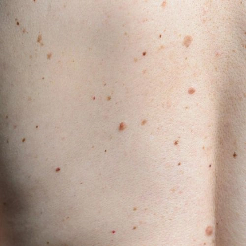 Xuất hiện các nốt ruồi son ngày càng nhiều có đáng lo ngại không?