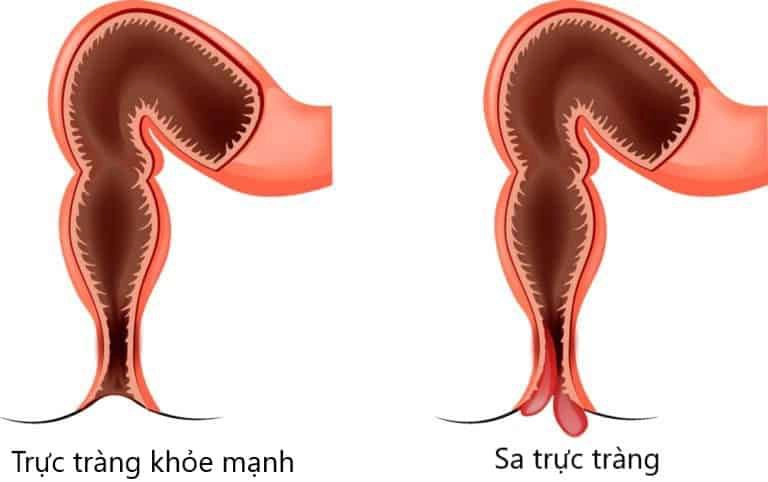 sa trực tràng