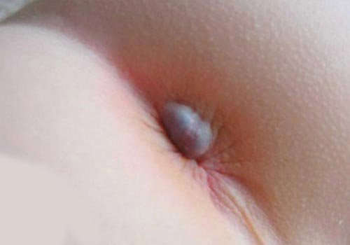 trẻ bị mọc mụn ở gần hậu môn