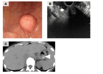 Nội soi dạ dày cho thấy một khối u dưới niêm mạc trong thân vị dạ dày