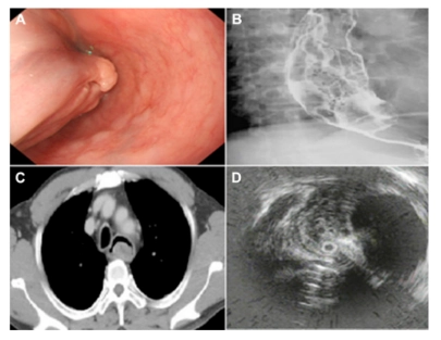 Khối u dạng sợi đơn độc thực quản. (A) Soi thực quản cho thấy một khối lớn có cuống chiếm toàn bộ lòng thực quản, được kéo dài đến đáy thực quản. (B) Chụp X quang  với  Barit cản quang  cho thấy nhiều khuyết thuốc không đều. (C) Chụp cắt lớp vi tín