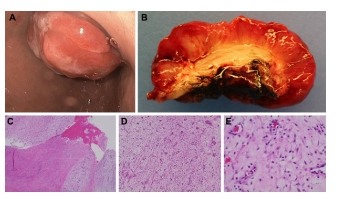 Các đặc điểm nội soi và giải phẫu bệnh của khối u Plexiform fibromyxoma dạ dày. Trên nội soi dạ dày, mô bở dễ vỡ vụn chia thùy khối được nhìn thấy ở  hang môn vị và cản trở dây soi qua môn vị (A). Khối u cho thấy bề mặt loét rộng (B). Các phần nhuộm