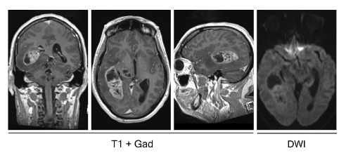 Hình 1. Phim MRI cho thấy khối u nguyên bào thần kinh đệm ở thái dương phải. Chuỗi xung T1 sau tiêm đối quang mặt phẳng coronal, axial, và sagittal (từ trái sang phải) cho thấy tổn thương bắt đối quang không đồng đều và có hiệu ứng choán chổ kèm phù nề,
