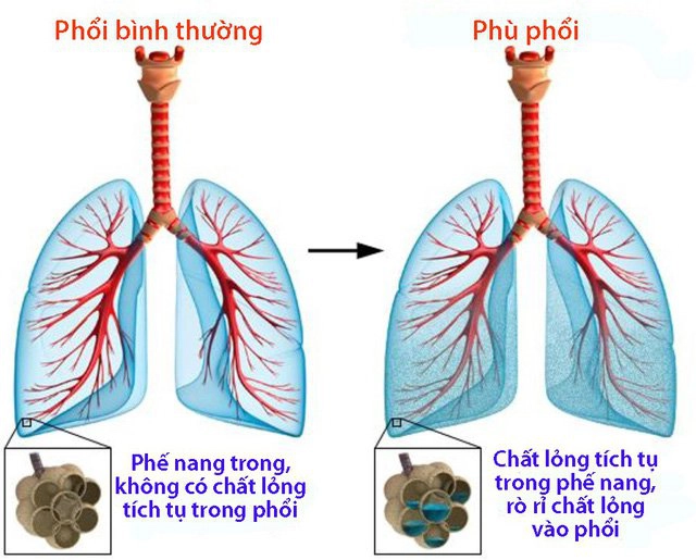 Hình ảnh phù phổi