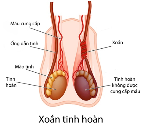 Chẩn đoán và điều trị xoắn tinh hoàn