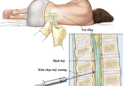 Chọc dịch tủy sống chẩn đoán viêm màng não