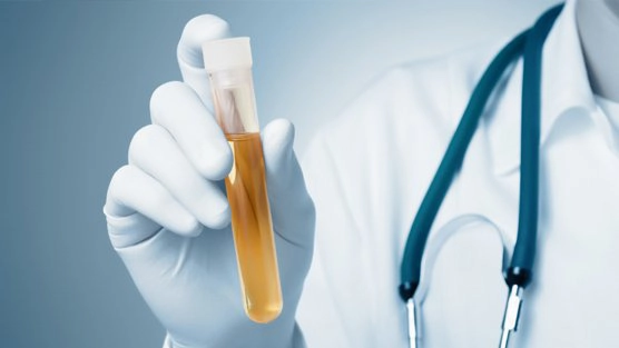 Xét nghiệm nước tiểu bạch cầu cao