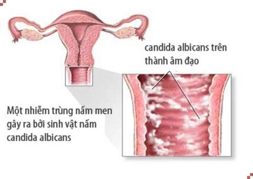 nhiễm trùng nấm men âm đạo