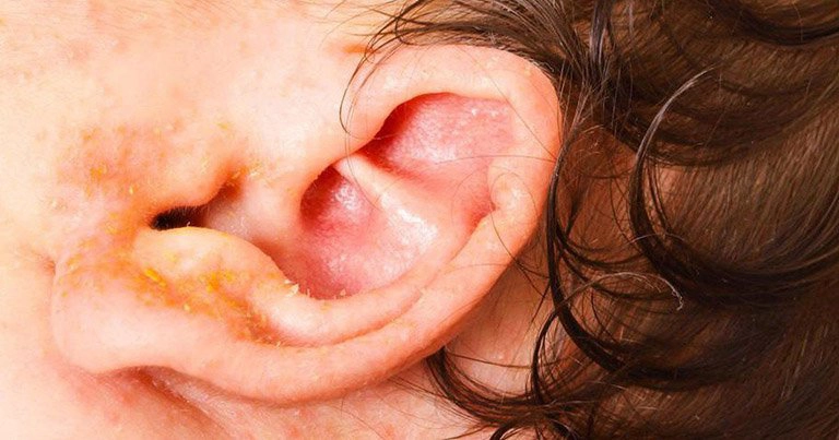 Chảy nước vàng ở vành tai