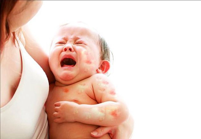 dị ứng sữa bò