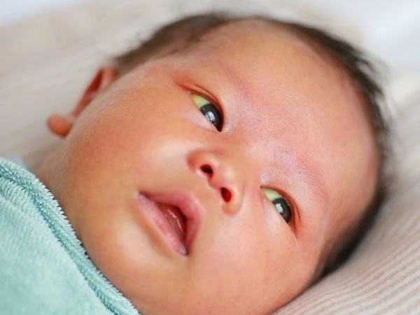 chỉ số bilirubin trong máu trẻ sơ sinh
