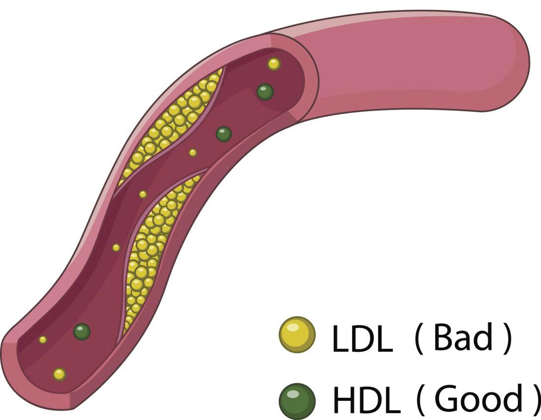 HDL