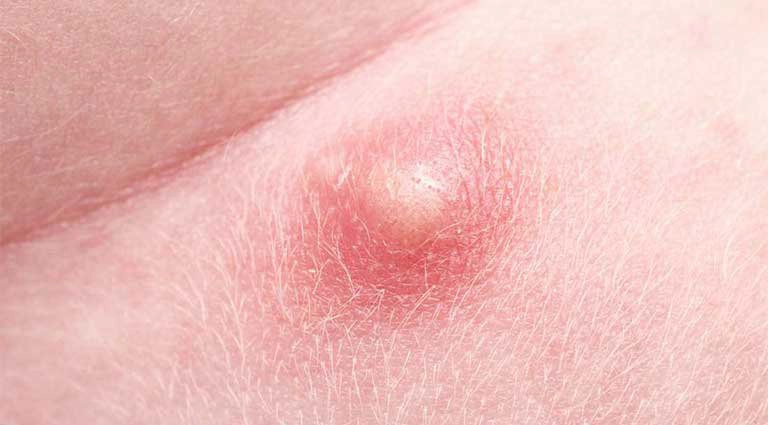 nổi mụn nhọt ở gần hậu môn
