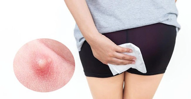 mụn nhọt ở hậu môn