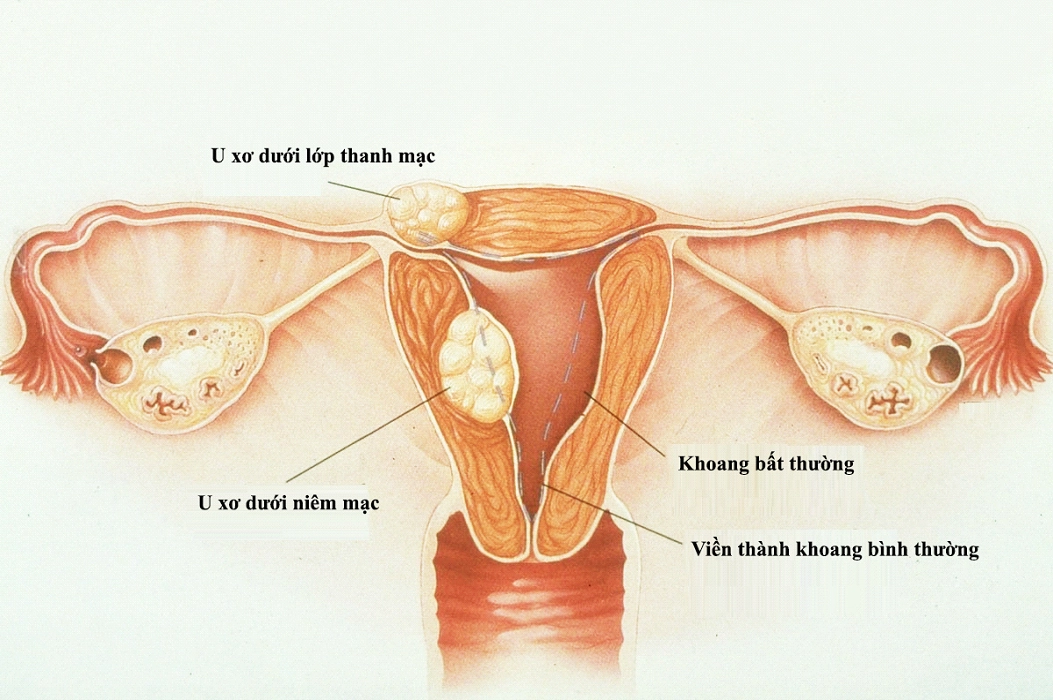 Chửa trứng ác tính: Những điều cần biết