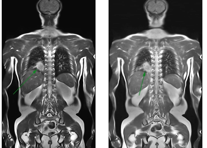 MRI toàn thân U phổi