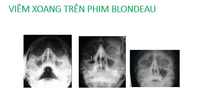 Viêm xoang trên phim Blondeau