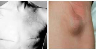 Nổi hạch ở nách đau nhức