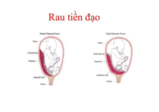 Thế nào là rau tiền đạo?