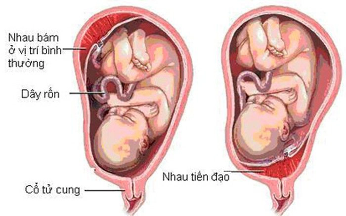 Biến chứng của rau tiền đạo ở bà bầu