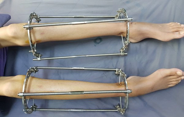 Phát triển chiều cao tuổi 20