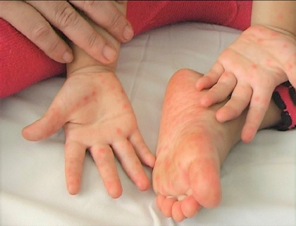 dấu hiệu cảnh báo tay chân miệng