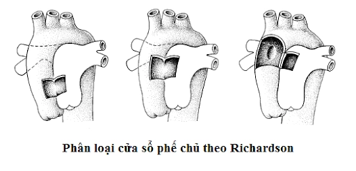 cửa sổ chủ phế