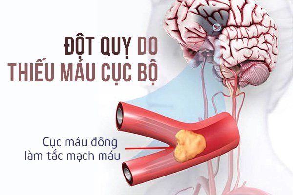 đột quỵ do thiếu máu cục bộ