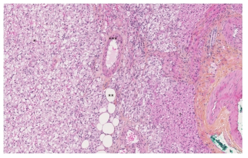 Hình  ảnh nhuộm Hematoxylin-Eosin-Saffron của u mạch gan. Có ba thành phần của u mạch gan: mạch (*), tế bào mỡ (**) và nhiều tế bào biểu mô (***). Có ít tế bào gan hơn (†) (độ phóng đại × 10).