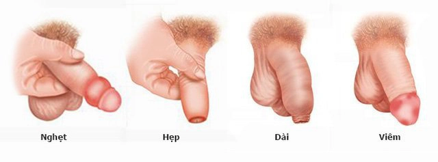 Dài bao quy đầu