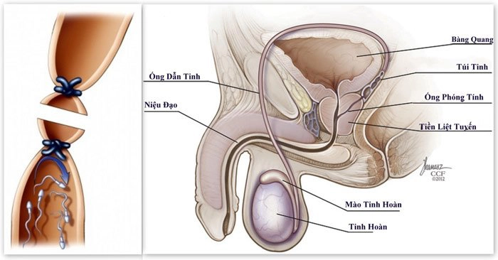 Phương pháp thắt ống dẫn tinh