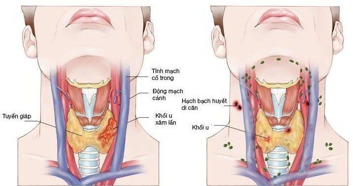 Ung thư vòm họng giai đoạn 4 điều trị như thế nào?