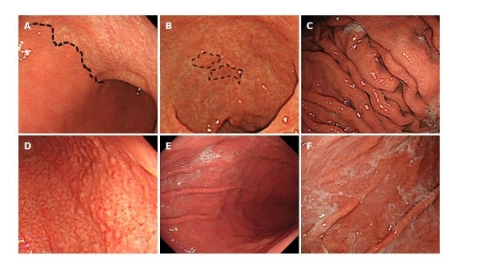 Viêm teo thân vị phía góc bờ cong nhỏ dạ dày, hậu quả của nhiễm H.pylori.