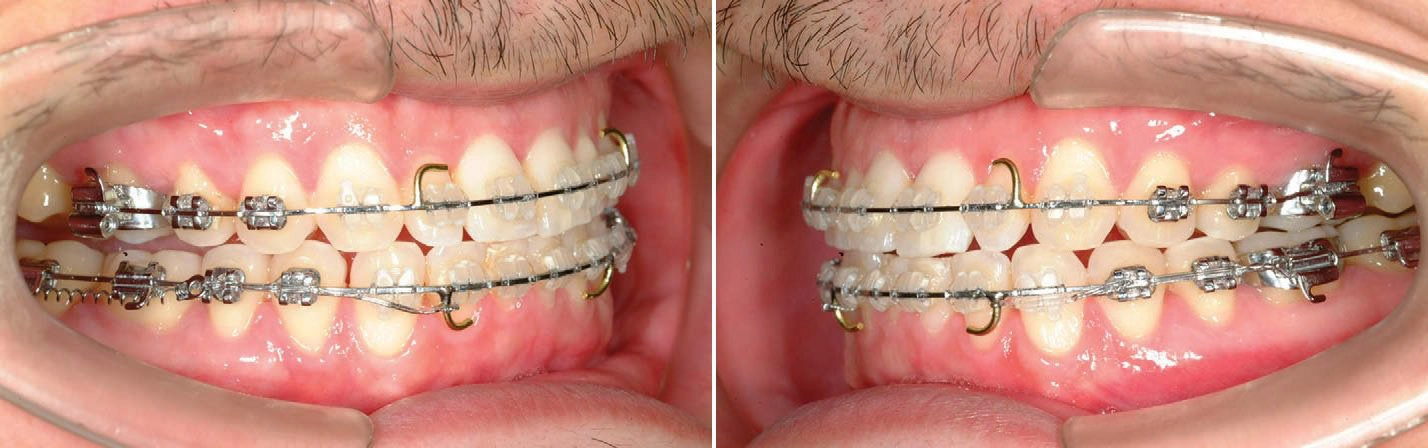 Đánh lún răng bằng minivis