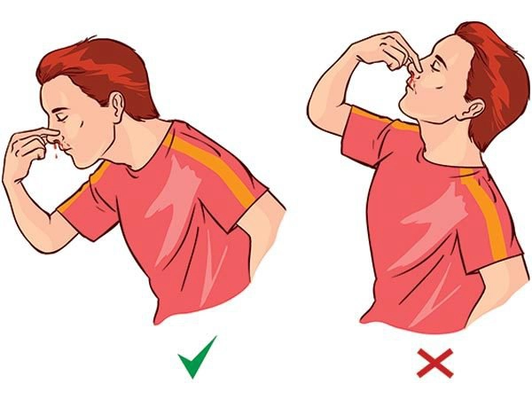 Sơ cứu đúng khi bị chảy máu cam