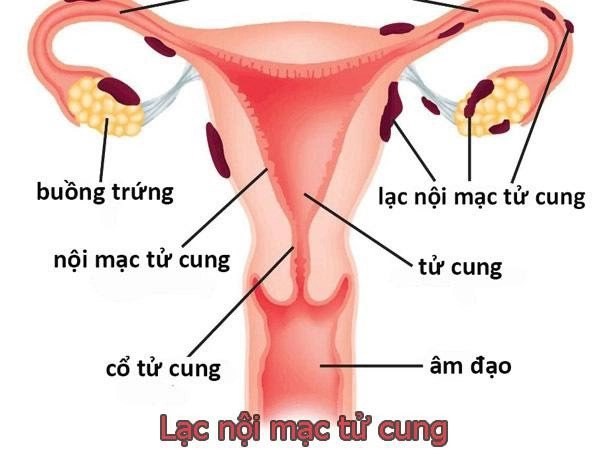 Điều trị dứt điểm lạc nội mạc tử cung như nào?