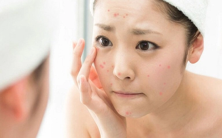 giảm dị ứng da mặt