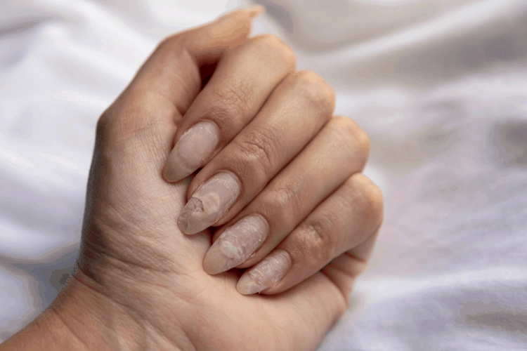 móng giòn, rất dễ nứt gã
