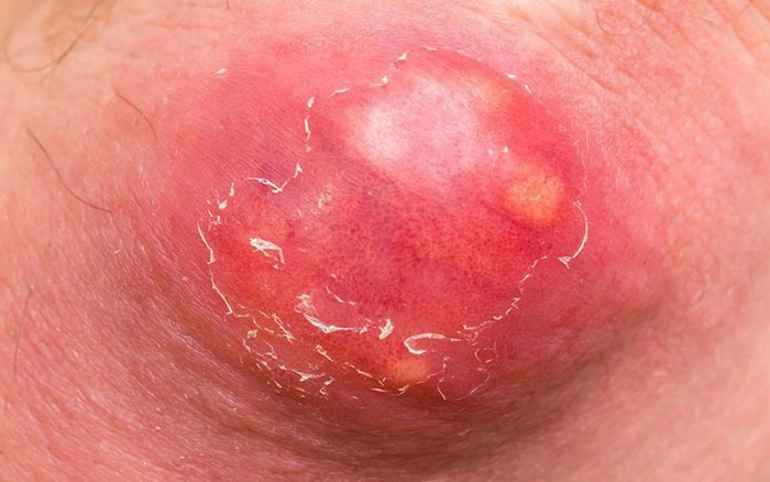 nhọt bị nhiễm trùng