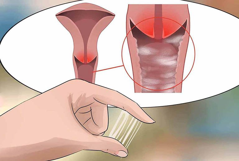 Viêm nhiễm phụ khoa