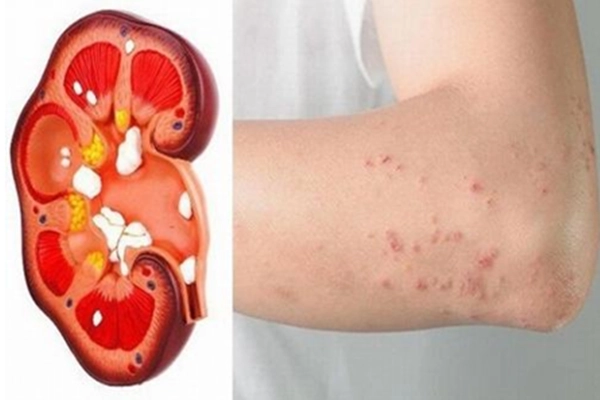 suy thận giai đoạn đầu