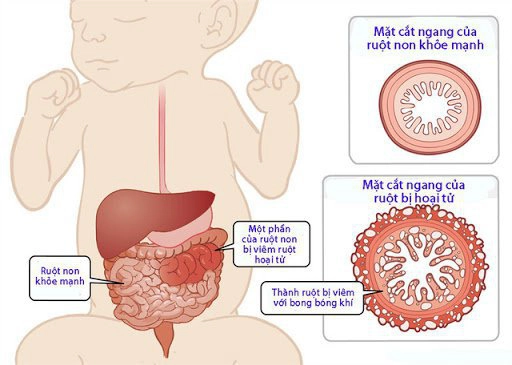 viêm ruột hoại tử ở trẻ sơ sinh