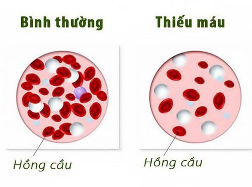 Đề phòng thiếu máu não ở trẻ em