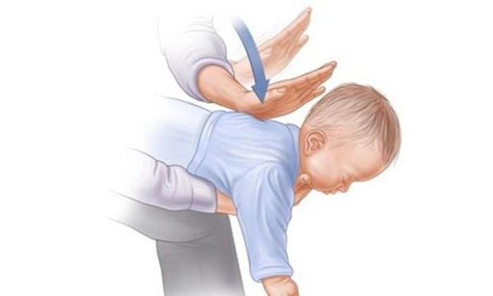 Thủ thuật Heimlich