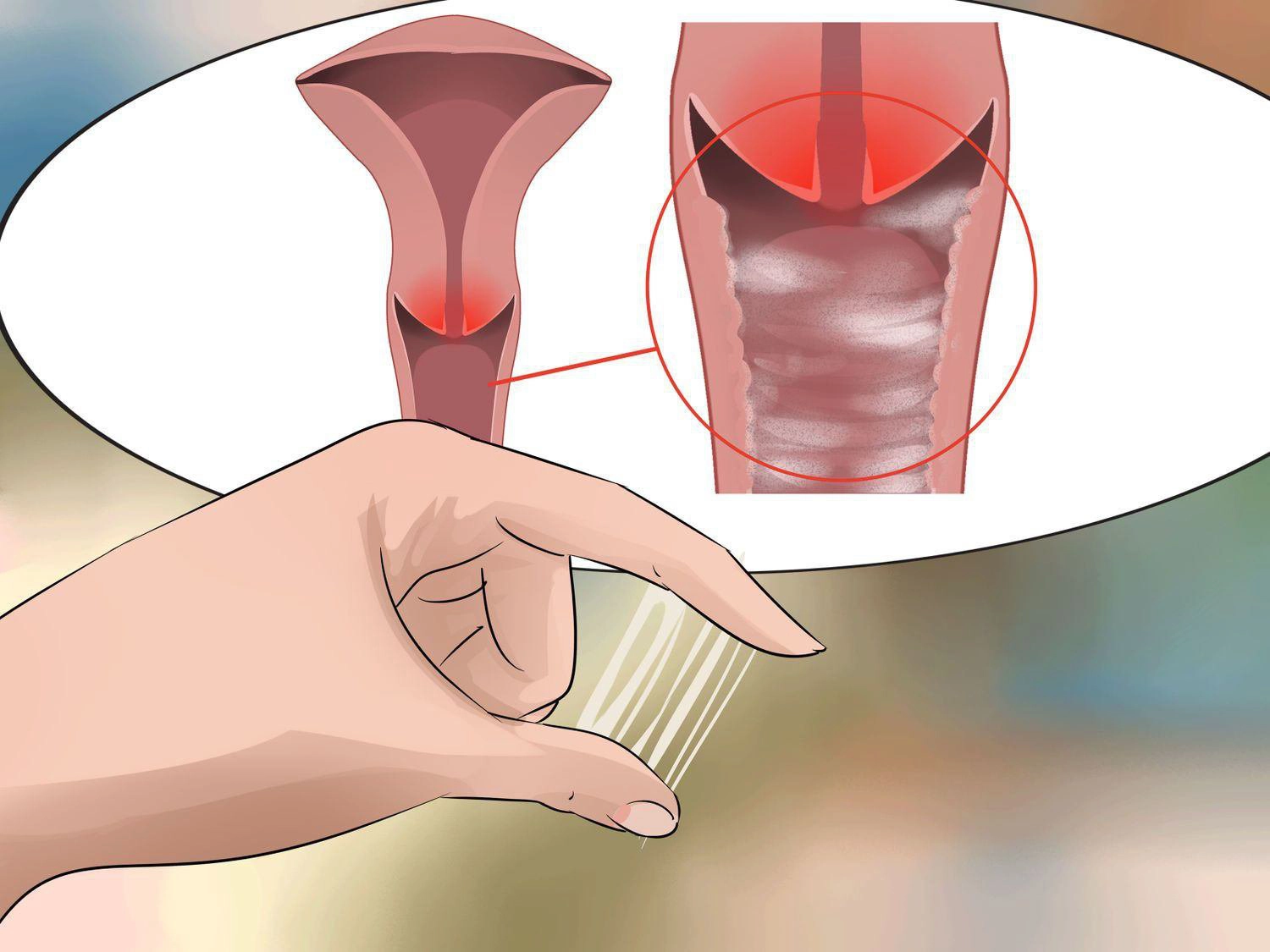 Viêm nhiễm âm đạo