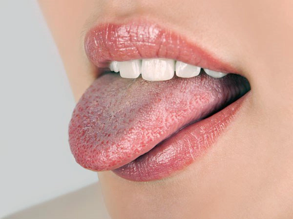bệnh nấm lưỡi