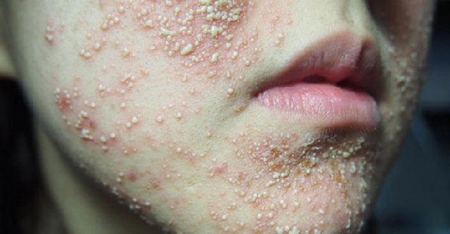 Điều trị da nhiễm corticoid