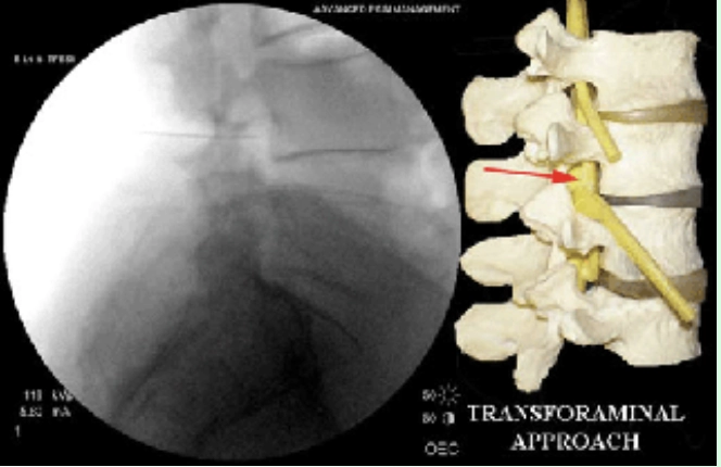 Hình 1. Tiêm thấm ngoài màng cứng qua lổ liên hợp (nguồn: completepaincare.com)